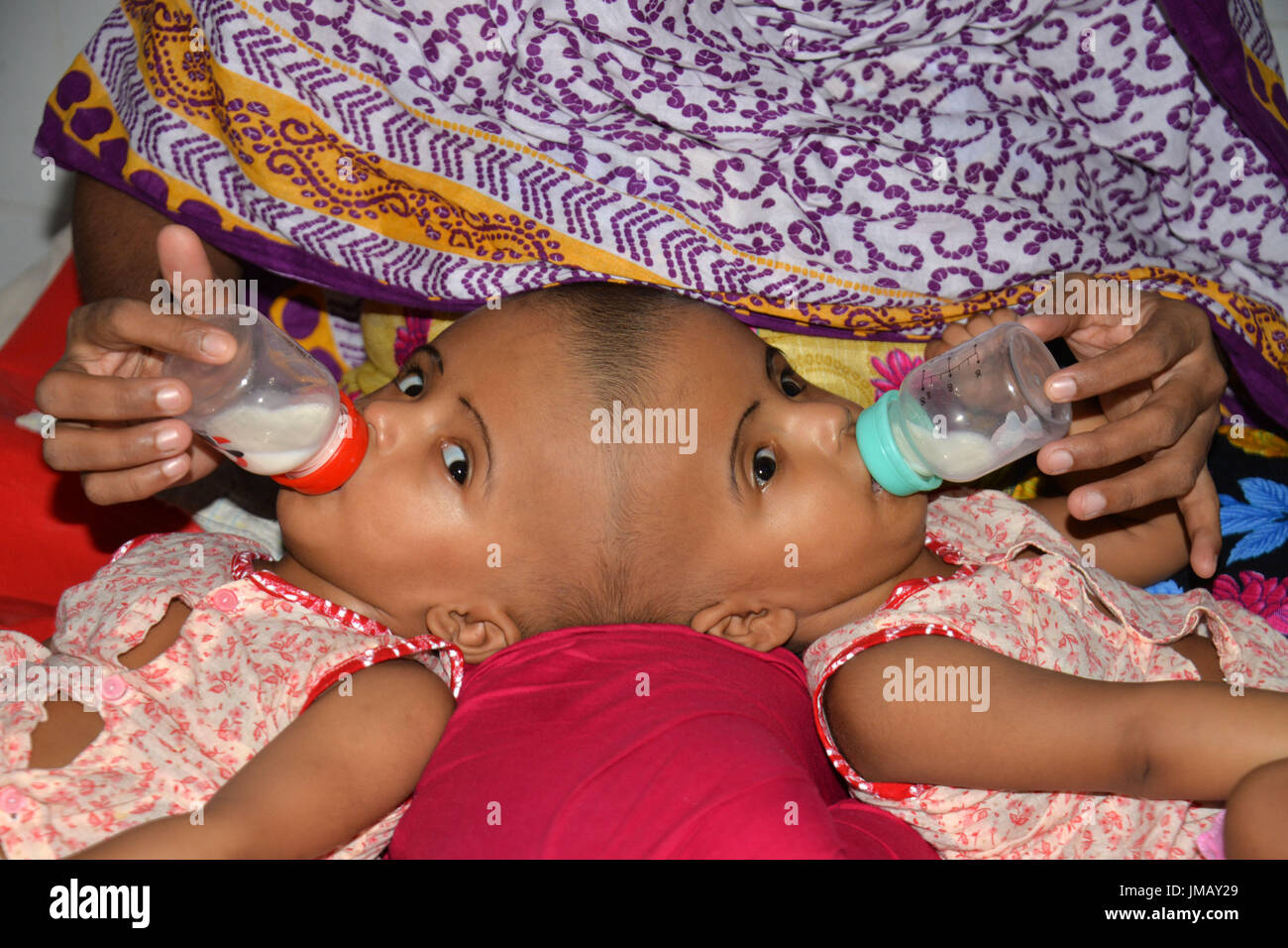 Dhaka Bangladesh 27 Juillet 17 Lits Jumeaux Siamois Bebe Filles Du Bangladesh A La Tete Sont Illustres A La Plus Grande Universite De Medecine Bangabandhu Sheikh Mujib Bsmmu A Dhaka Capitale Du