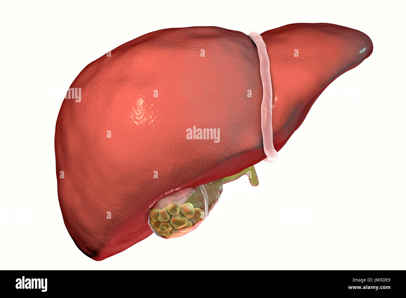 Les calculs biliaires. Illustration montrant le foie et la vésicule biliaire avec des calculs biliaires. La vésicule biliaire stocke la bile, le liquide digestif qui est produit par le foie (ci-dessus) de la vésicule biliaire et transmise à l'intestin grêle. Les calculs biliaires, dépôts durs formés de cholestérol et de sels biliaires se forment dans la vésicule, lorsqu'il y a un déséquilibre dans la composition chimique de la bile. Les calculs biliaires sont habituellement sans symptômes, à moins que l'on obstrue le canal cholédoque, causant la douleur aiguë, la jaunisse et l'infection. Le traitement est avec des médicaments pour dissoudre les pierres ou l'ablation de la vésicule biliaire. Banque D'Images