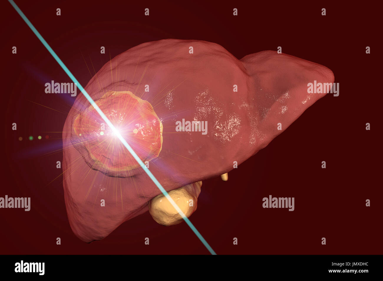 Laserotherapy dans le traitement du cancer du foie, de l'image conceptuelle. Banque D'Images