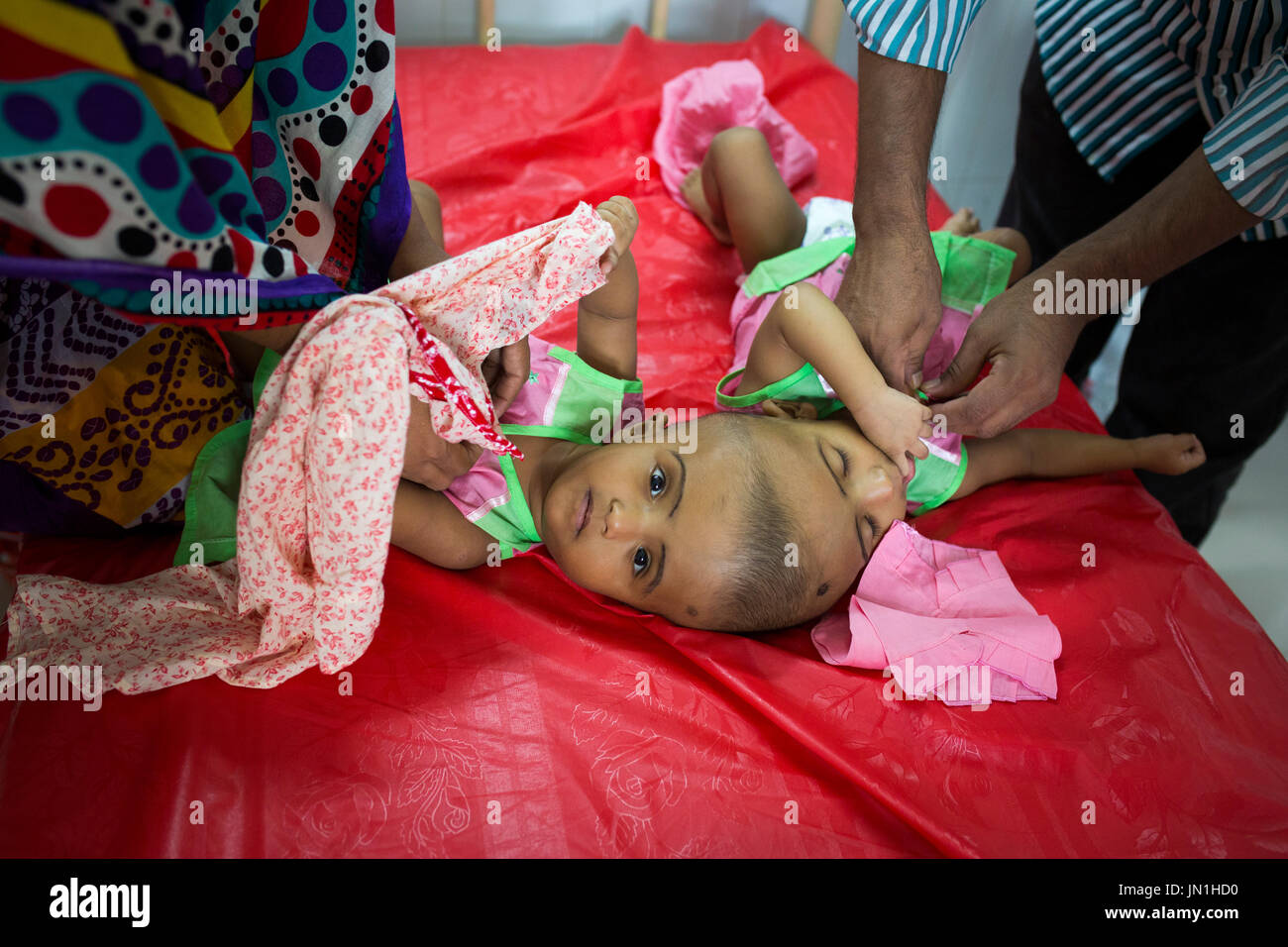 Dhaka, Bangladesh. 29 juillet, 2017. DHAKA, BANGLADESH - 29 juillet : lits jumeaux siamois filles Rabeya l'Islam et l'Islam Rokeya jouer dans un hôpital à Dhaka, Bangladesh, le 29 juillet 2017. Taslima Khatun, professeur d'école, a donné une naissance de jumeaux siamois le dirigé le 16 juillet 2016 après une césarienne. Les jumeaux ont été admis à un hôpital du gouvernement pour examen avant la chirurgie potentiellement à séparer leurs têtes. Zakir Hossain Chowdhury Crédit : zakir/Alamy Live News Banque D'Images