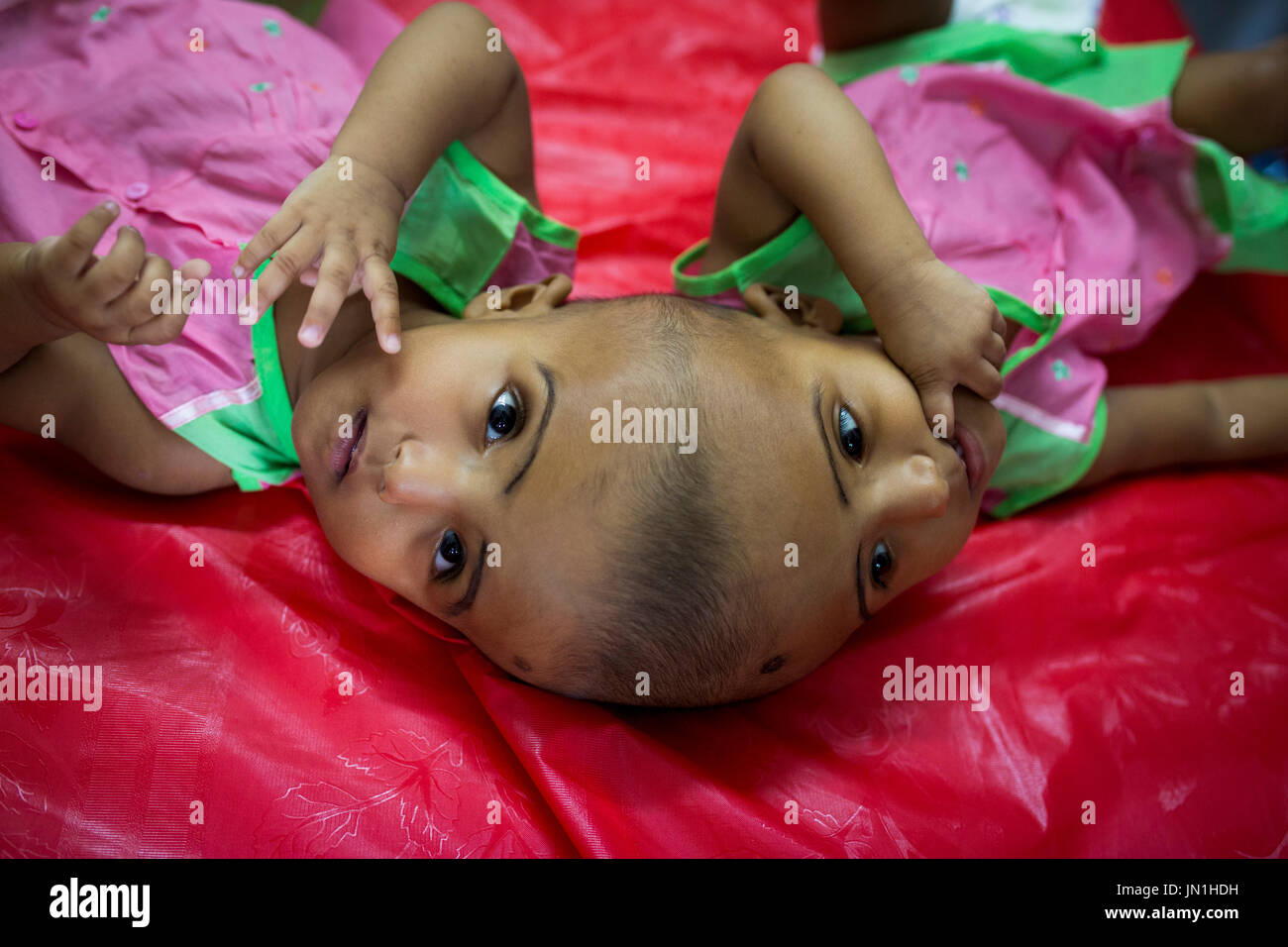 Dhaka, Bangladesh. 29 juillet, 2017. DHAKA, BANGLADESH - 29 juillet : lits jumeaux siamois filles Rabeya l'Islam et l'Islam Rokeya jouer dans un hôpital à Dhaka, Bangladesh, le 29 juillet 2017. Taslima Khatun, professeur d'école, a donné une naissance de jumeaux siamois le dirigé le 16 juillet 2016 après une césarienne. Les jumeaux ont été admis à un hôpital du gouvernement pour examen avant la chirurgie potentiellement à séparer leurs têtes. Zakir Hossain Chowdhury Crédit : zakir/Alamy Live News Banque D'Images