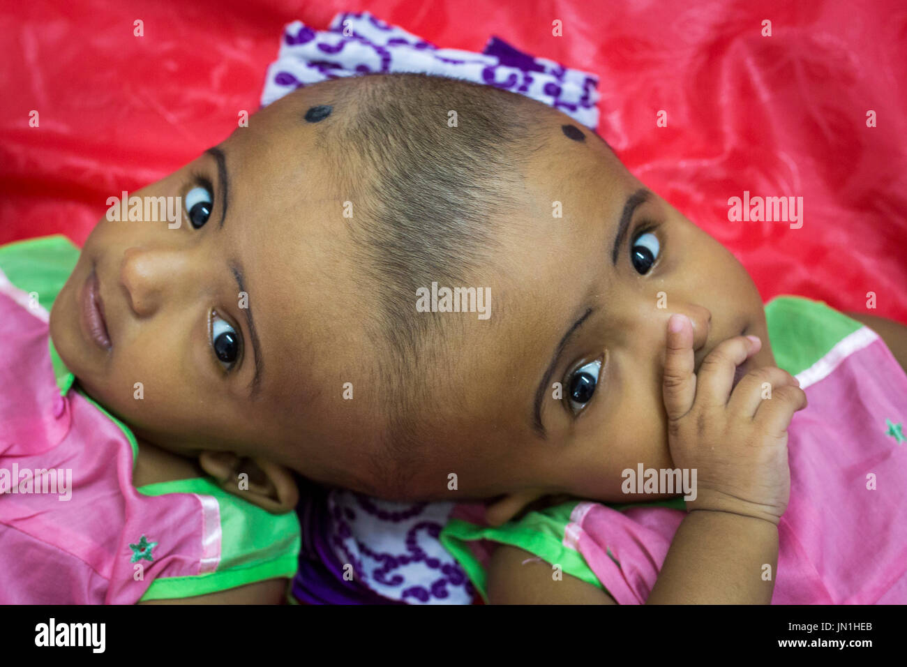 Dhaka, Bangladesh. 29 juillet, 2017. DHAKA, BANGLADESH - 29 juillet : lits jumeaux siamois filles Rabeya l'Islam et l'Islam Rokeya jouer dans un hôpital à Dhaka, Bangladesh, le 29 juillet 2017. Taslima Khatun, professeur d'école, a donné une naissance de jumeaux siamois le dirigé le 16 juillet 2016 après une césarienne. Les jumeaux ont été admis à un hôpital du gouvernement pour examen avant la chirurgie potentiellement à séparer leurs têtes. Zakir Hossain Chowdhury Crédit : zakir/Alamy Live News Banque D'Images