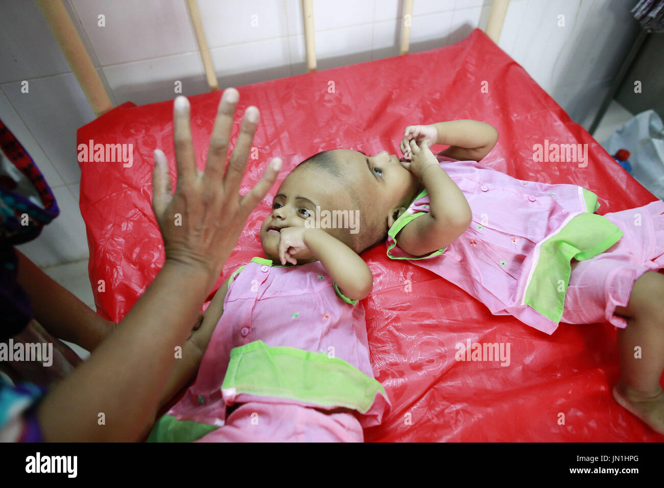 Dhaka, Bangladesh. 29 juillet, 2017. Les filles jumelles de conjoined bangladais et Rabeya Rokeya jeter sur lit d'hôpital à Dhaka, Bangladesh, le 29 juillet 2017. Credit : Suvra Kanti Das/ZUMA/Alamy Fil Live News Banque D'Images