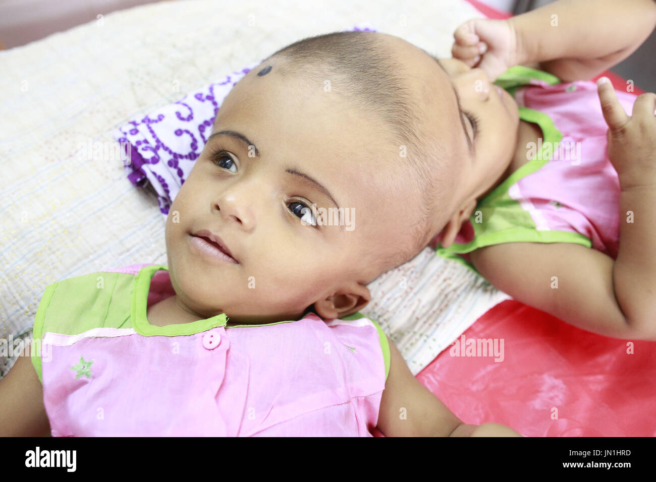 Dhaka, Bangladesh. 29 juillet, 2017. Les filles jumelles de conjoined bangladais et Rabeya Rokeya jeter sur lit d'hôpital à Dhaka, Bangladesh, le 29 juillet 2017. Credit : Suvra Kanti Das/ZUMA/Alamy Fil Live News Banque D'Images