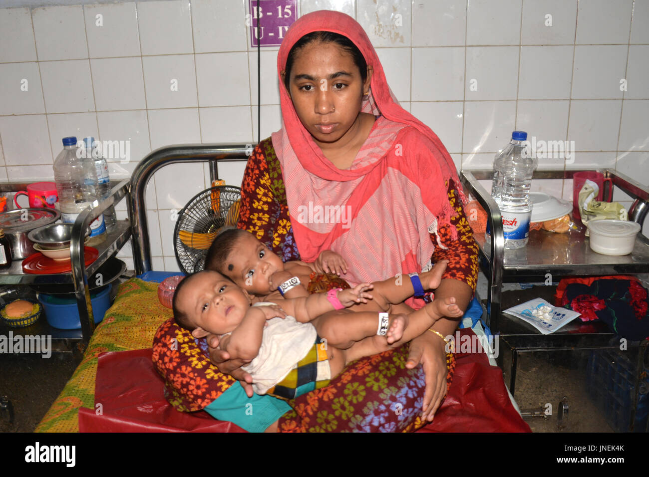Dhaka Bangladesh 30 Juillet 17 Lits Jumeaux Siamois Bebe Filles Du Bangladesh A La Colonne Vertebrale Se Trouvent Dans Les Bras De Leur Mere Au Plus Grand Du Bangladesh Dhaka Medical College Dhaka Bangladesh 30 Juillet 17 Lits Jumeaux Siamois Bebe Filles Du Bangladesh A La Colonne Vertebrale Se Trouvent Dans Les Bras De Leur Mere Au Plus Grand Du Bangladesh Dhaka Medical College