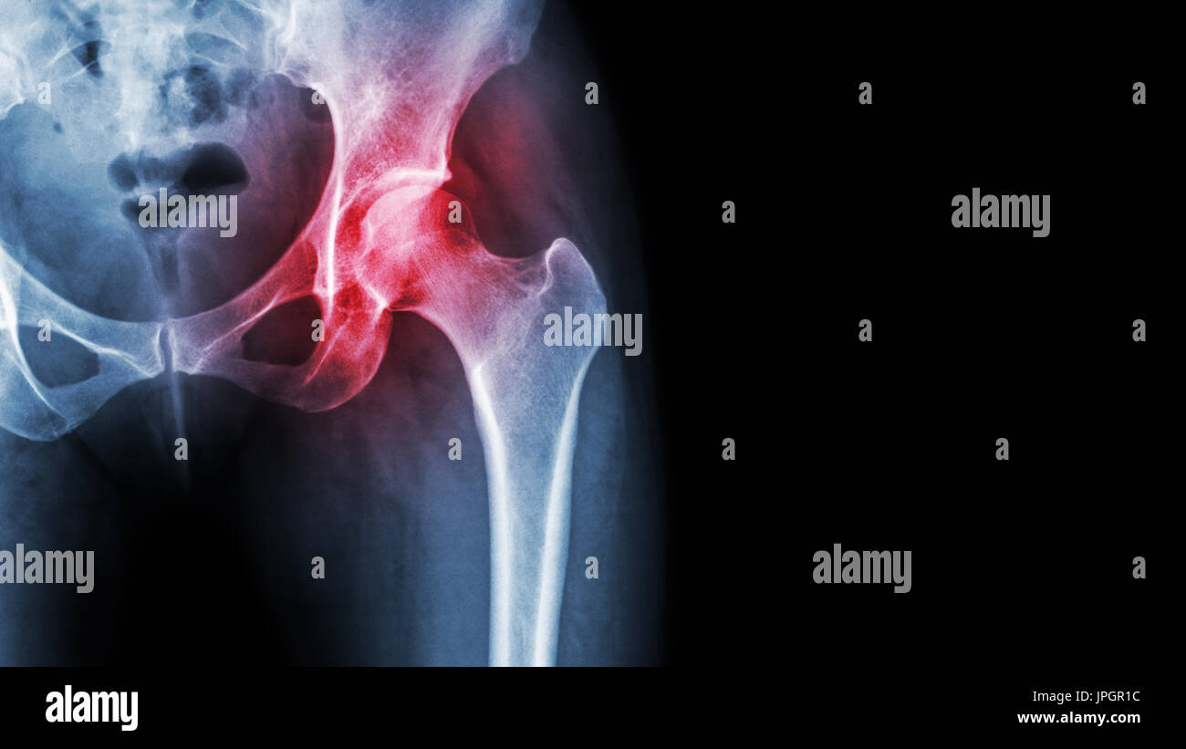 L'arthrite à la hanche . Film x-ray show enflammé de hanche et la zone vide du côté droit . La nécrose avasculaire concept . Banque D'Images