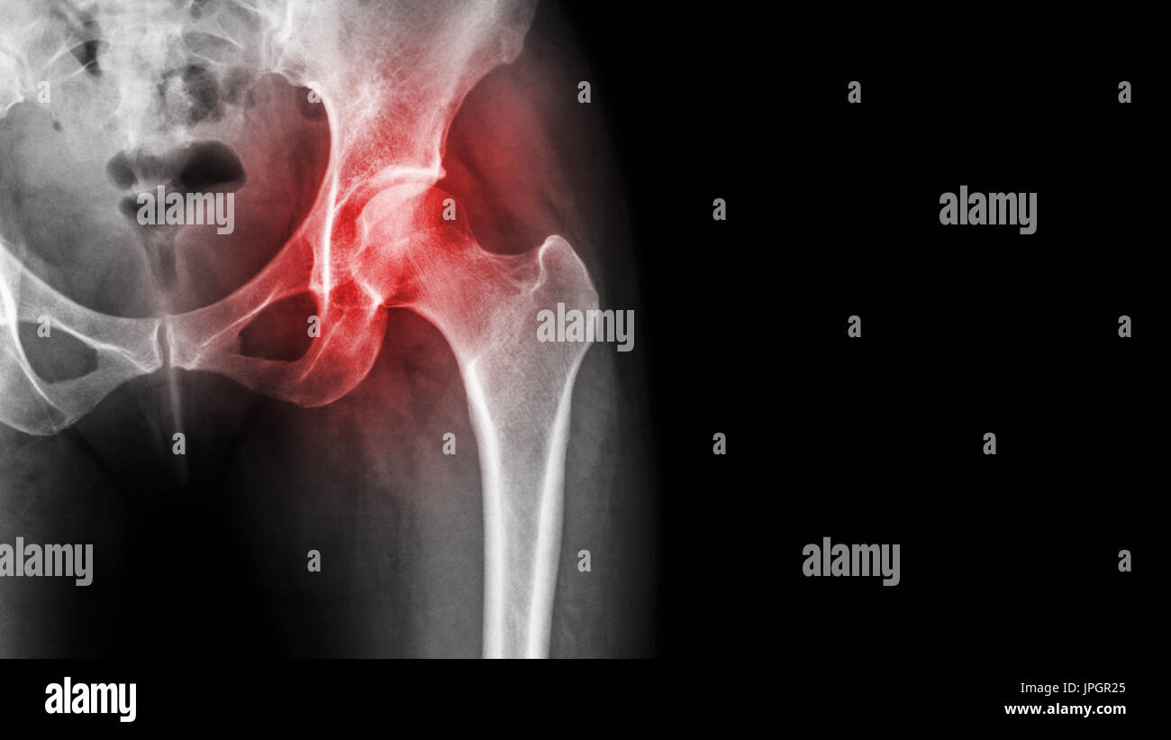 L'arthrite à la hanche . Film x-ray show enflammé de hanche et la zone vide du côté droit . La nécrose avasculaire concept . Banque D'Images