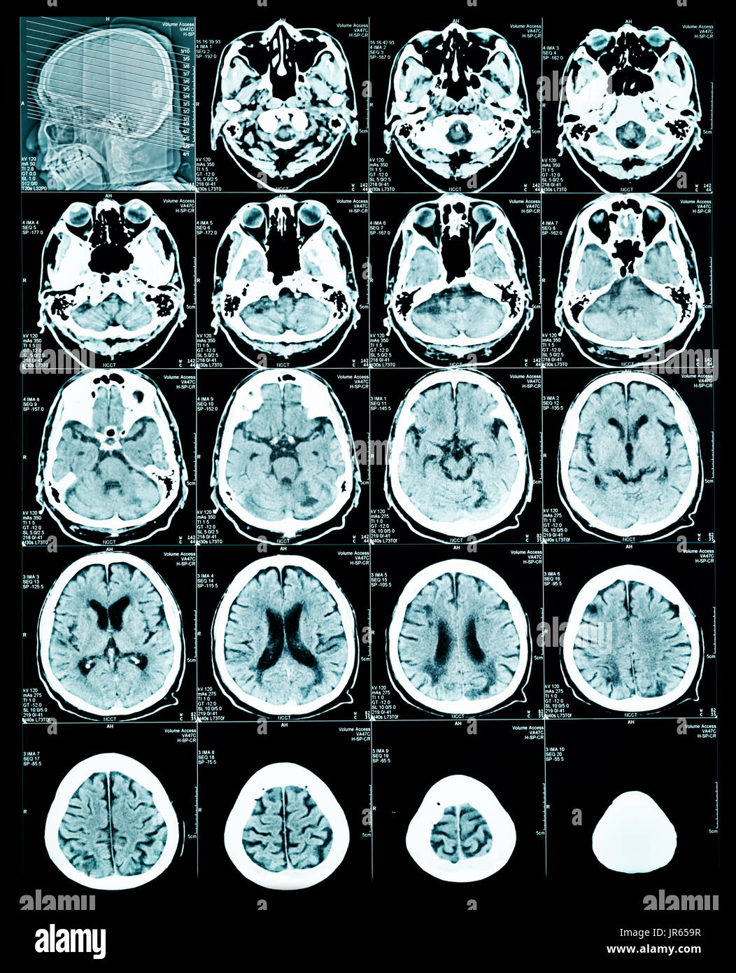 Irm cérébrale pour le diagnostic de l'image Banque D'Images