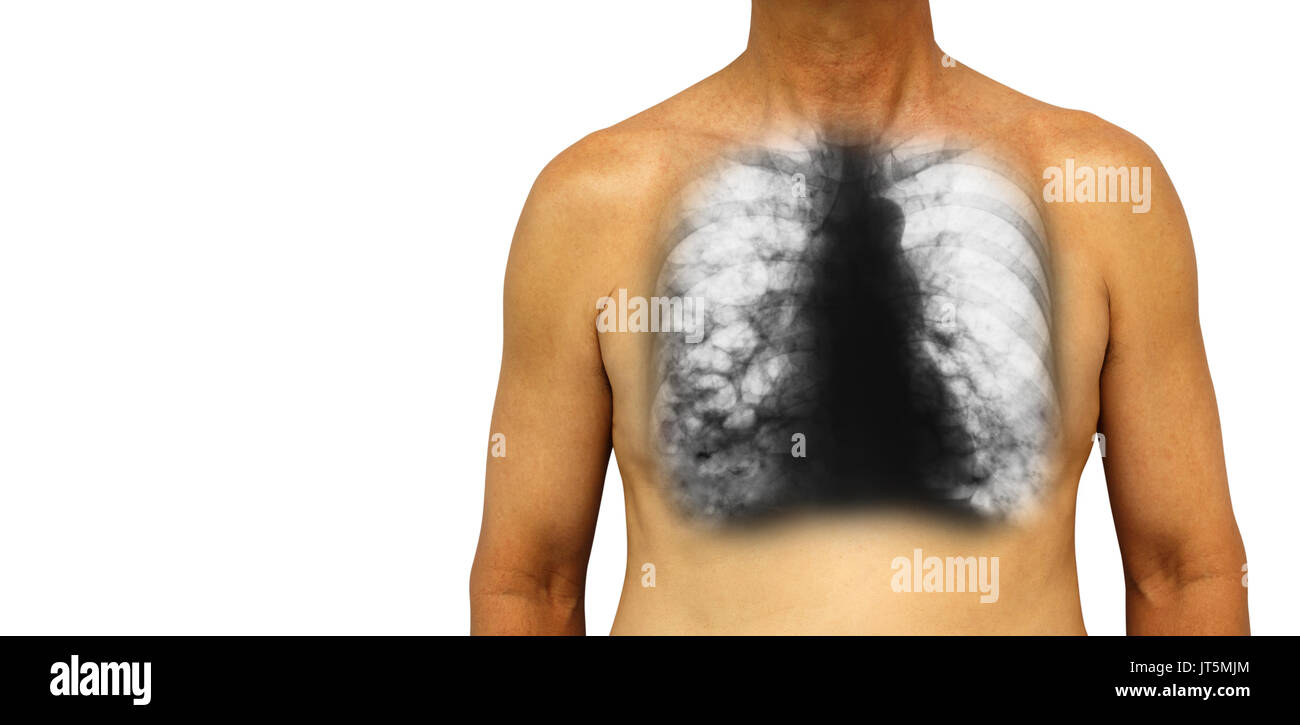 La bronchiectasie . La poitrine avec x-ray poitrine afficher de multiples kystes pulmonaires bleb et en raison de l'infection chronique . Fond isolé . Zone vide à gauche tr Banque D'Images