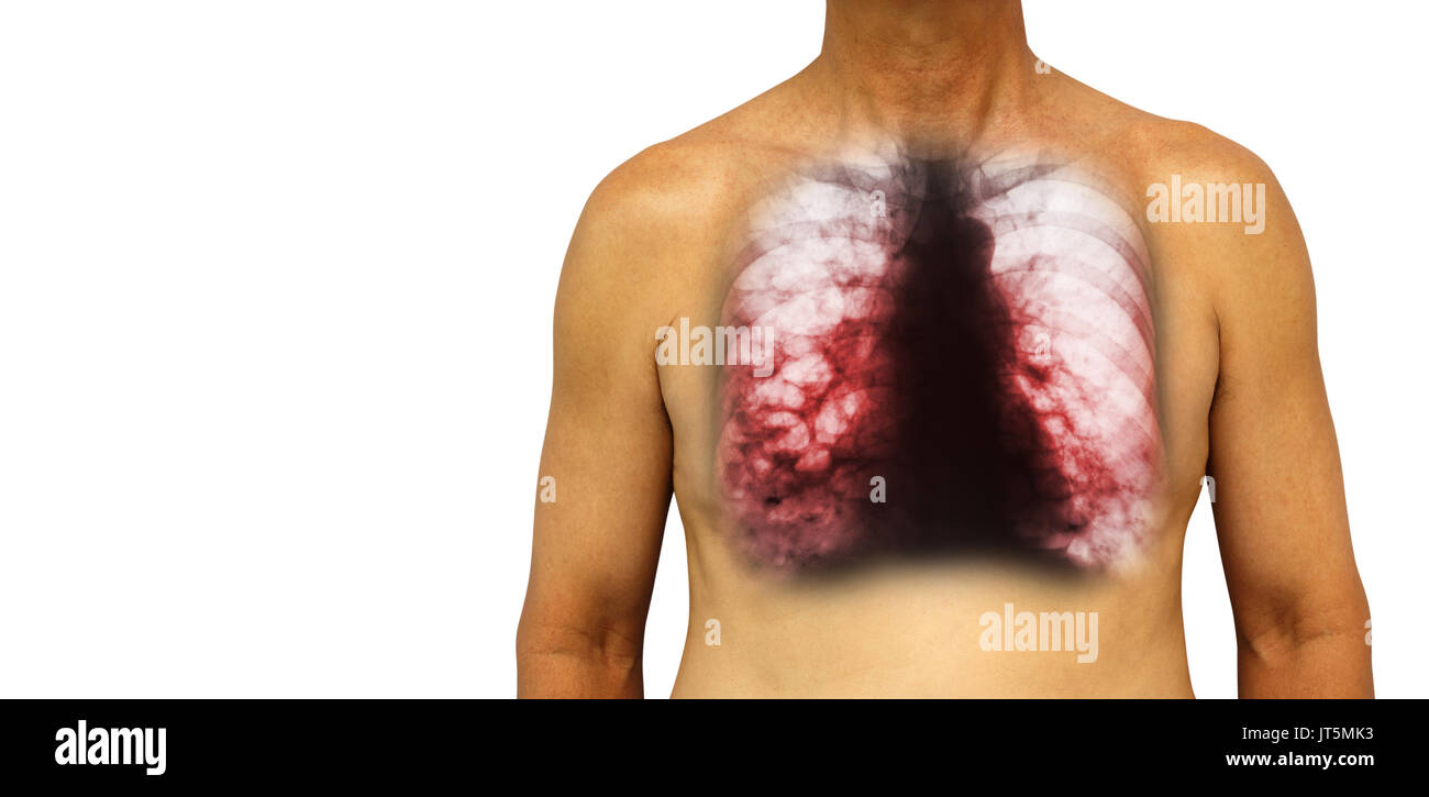 La bronchiectasie . La poitrine avec x-ray poitrine afficher de multiples kystes pulmonaires bleb et en raison de l'infection chronique . Fond isolé . Zone vide à gauche tr Banque D'Images