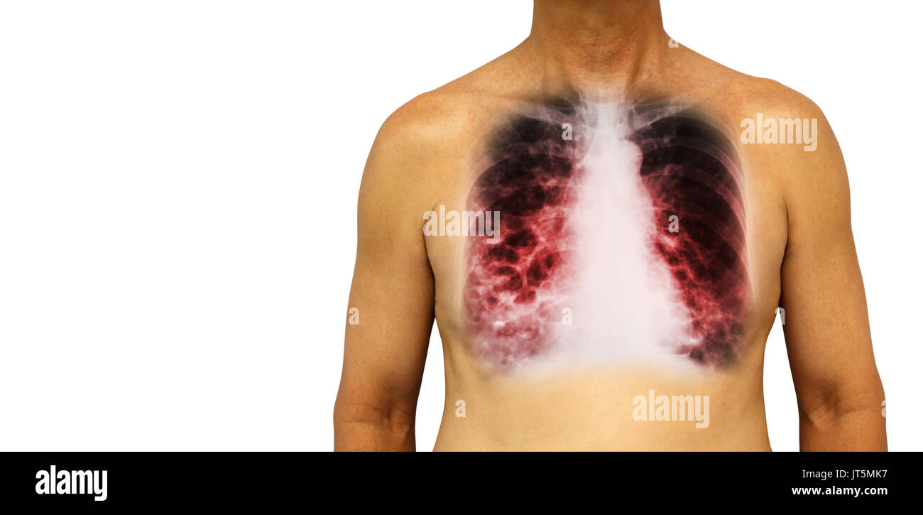 La bronchiectasie . La poitrine avec x-ray poitrine afficher de multiples kystes pulmonaires bleb et en raison de l'infection chronique . Fond isolé . Zone vide à gauche tr Banque D'Images