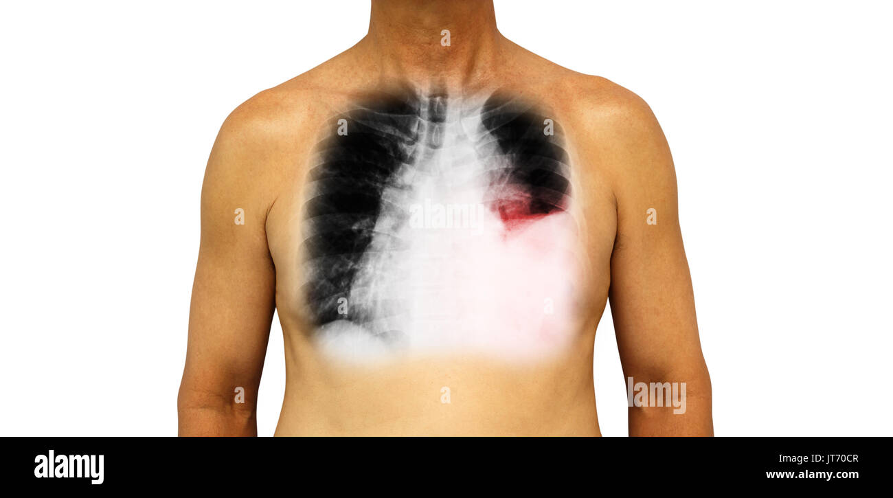 Le cancer du poumon . La poitrine et les rayons x montrent l'effusion pleurale poumon gauche due au cancer du poumon . Banque D'Images