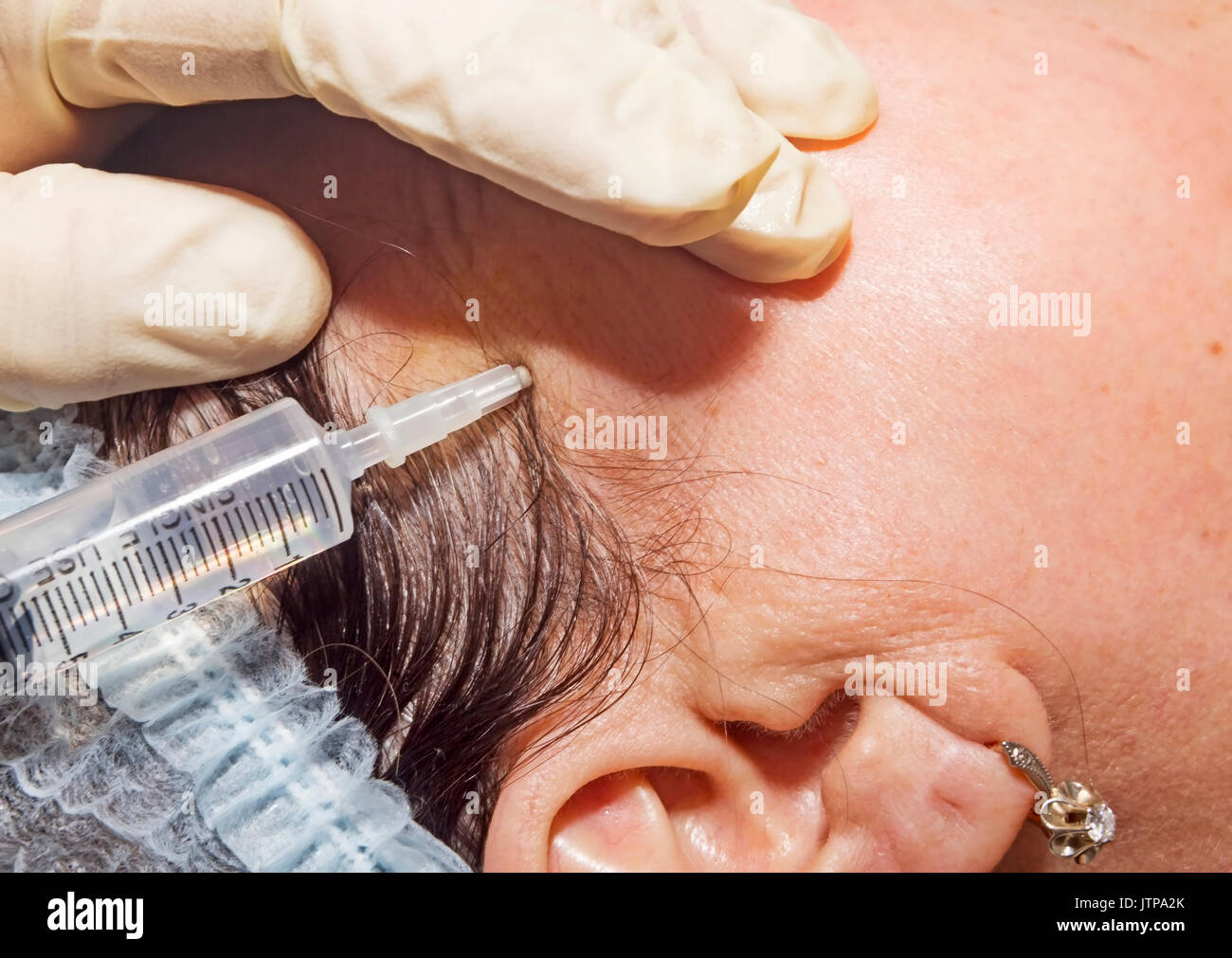 Le dermatologue effectue une anesthésie locale pour préparer le patient pour le visage pour le visage avec de l'acide lactique poly ligne - Selective focus Banque D'Images