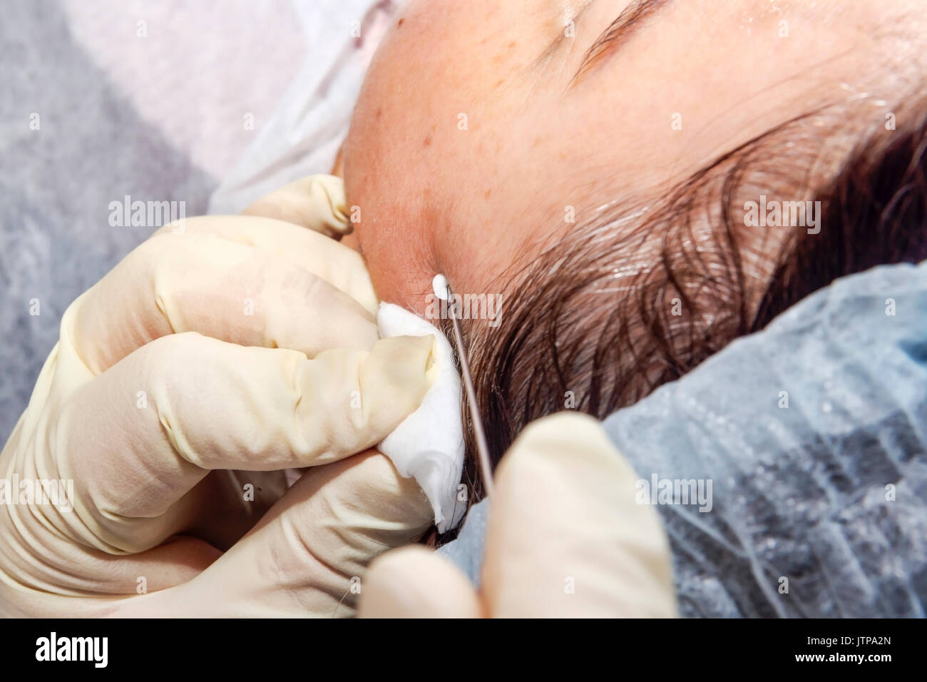 Chirurgien dermatologue insère des filaments d'acide polylactique pour effectuer la levée du visage - Selective focus Banque D'Images