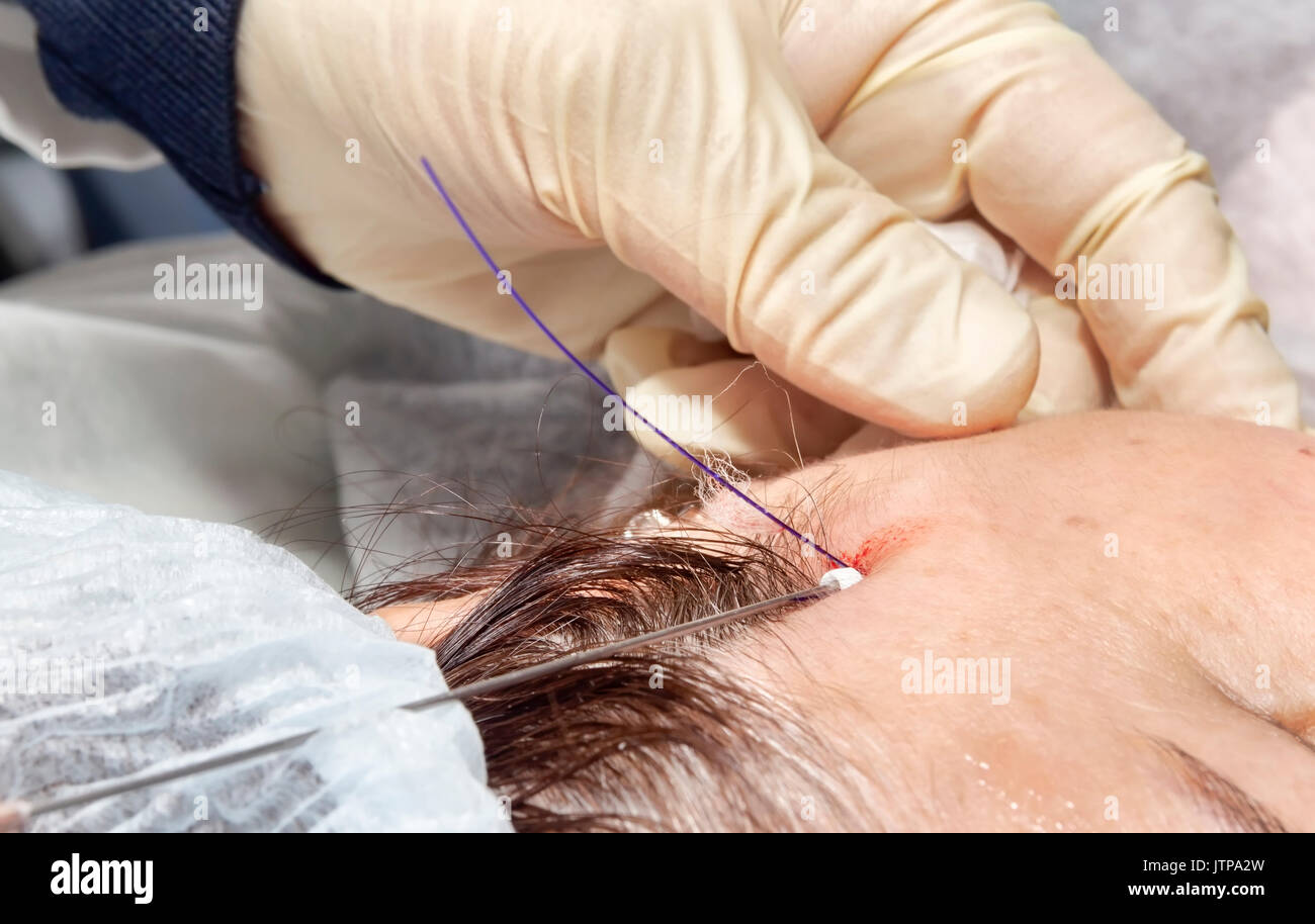 Chirurgien dermatologue insère des filaments d'acide polylactique pour effectuer la levée du visage - Selective focus Banque D'Images