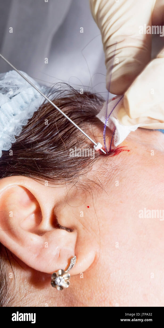 Chirurgien dermatologue insère des filaments d'acide polylactique pour effectuer la levée du visage - Selective focus Banque D'Images