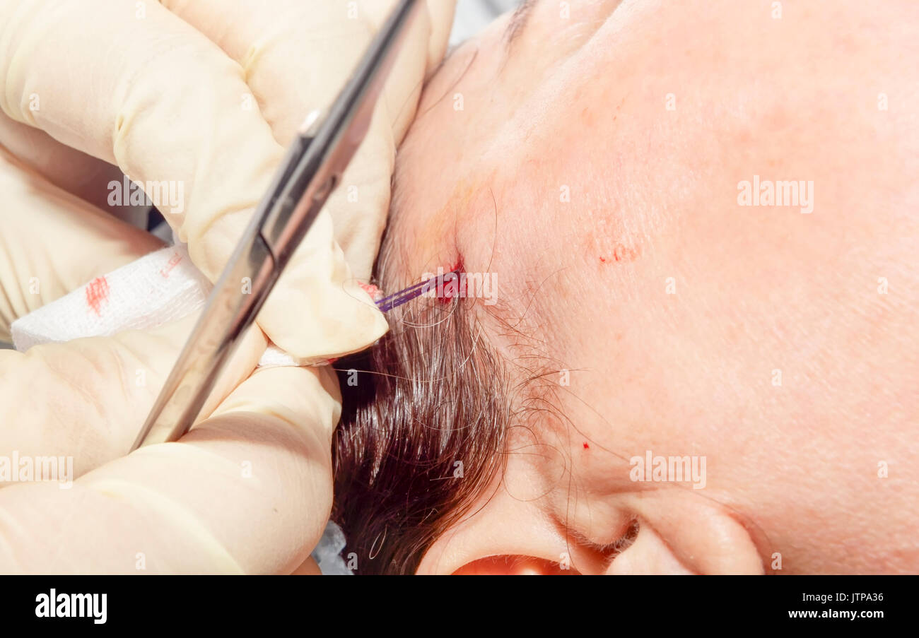Chirurgien dermatologue filaments tire d'effectuer la levée du visage avec des filaments d'acide polylactique - Selective focus Banque D'Images