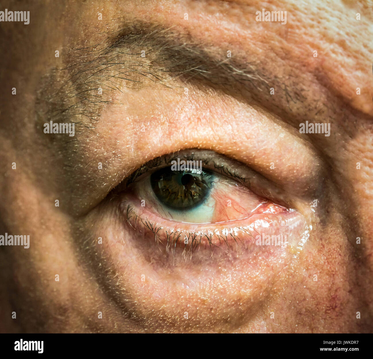 De près de l'oeil avec pseudopterygium après un an de carcinome épidermoïde de la conjonctive extraction chirurgicale Banque D'Images