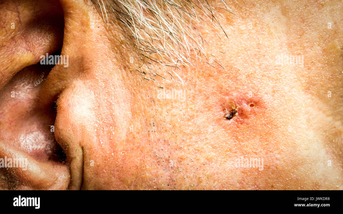 Un carcinome baso-cellulaire sur le visage de l'homme plus âgé avant chirurgie - libre Banque D'Images