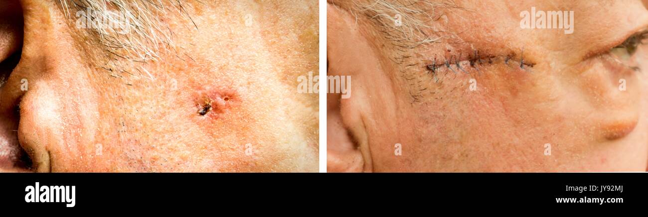 Un carcinome baso-cellulaire sur le visage de l'homme plus âgé avant et après la chirurgie - libre Banque D'Images