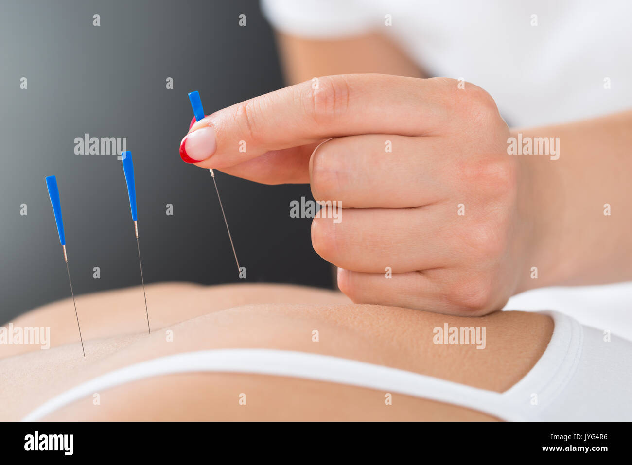 Close-up du thérapeute mains mettre aiguille d'Acupuncture On Woman's Back Banque D'Images