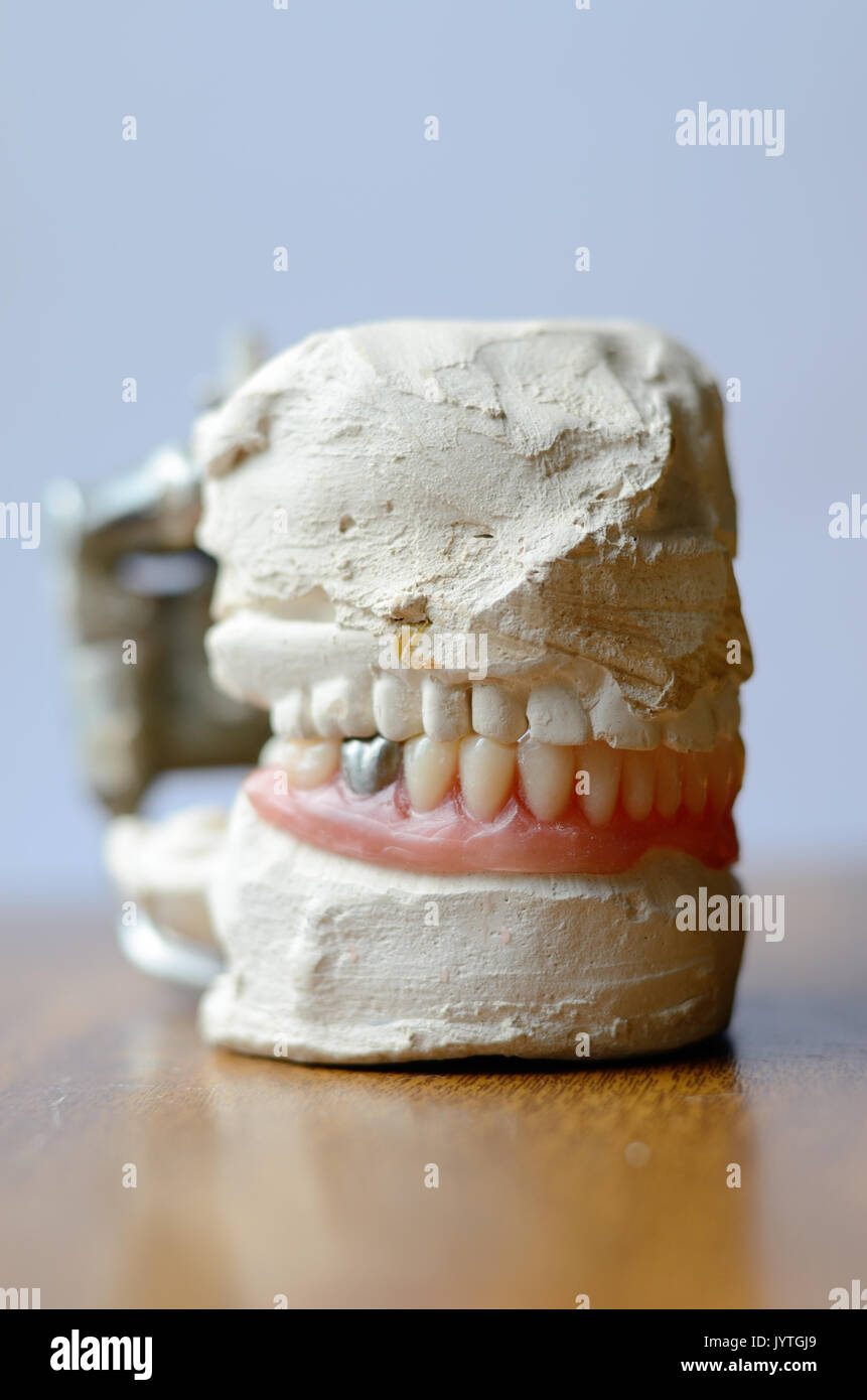 Dent artificielle, prothèse dentaire avec de fausses dents en métal argenté, la couronne sur la dent. Dentier Banque D'Images