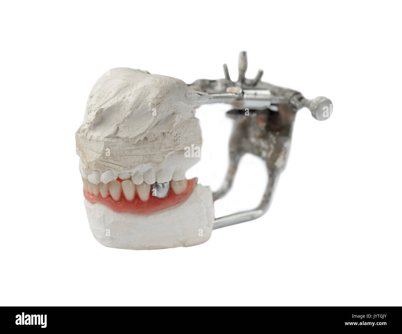 Dent artificielle, prothèse dentaire avec de fausses dents en métal argenté, la couronne sur la dent. Dentier Banque D'Images