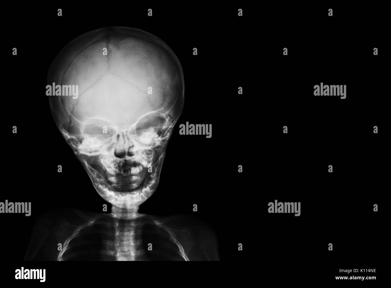 Film x-ray le crâne et corps d'enfant et la zone vide du côté droit . Banque D'Images