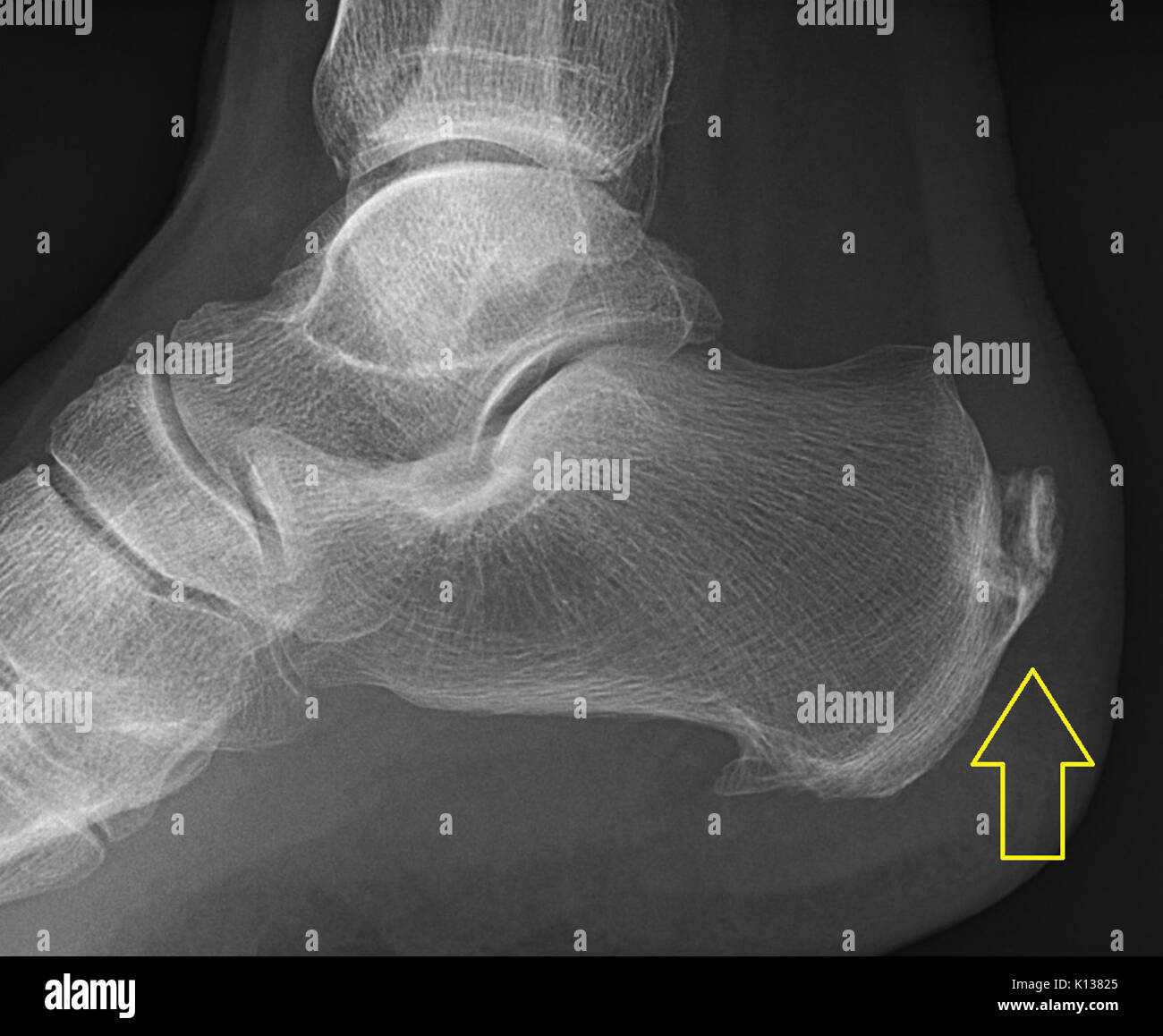 Insertion d'achille tendinosis calcifiée (marqué) Banque D'Images