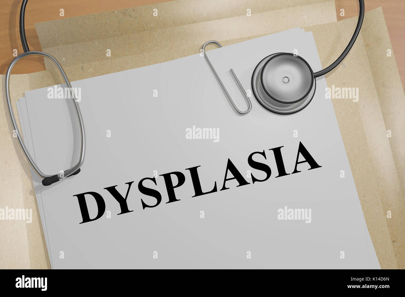 3D illustration de "YSPLASIA» titre sur un document médical Banque D'Images