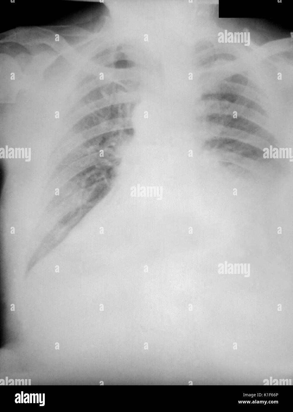 Radiographie thoracique de l'anthrax, 4e jour de la maladie. Radiographie pulmonaire de la PA prise le 4ème jour de la maladie, anthrax. Rayons X. Image avec l'aimable autorisation de CDC, 1966. Banque D'Images