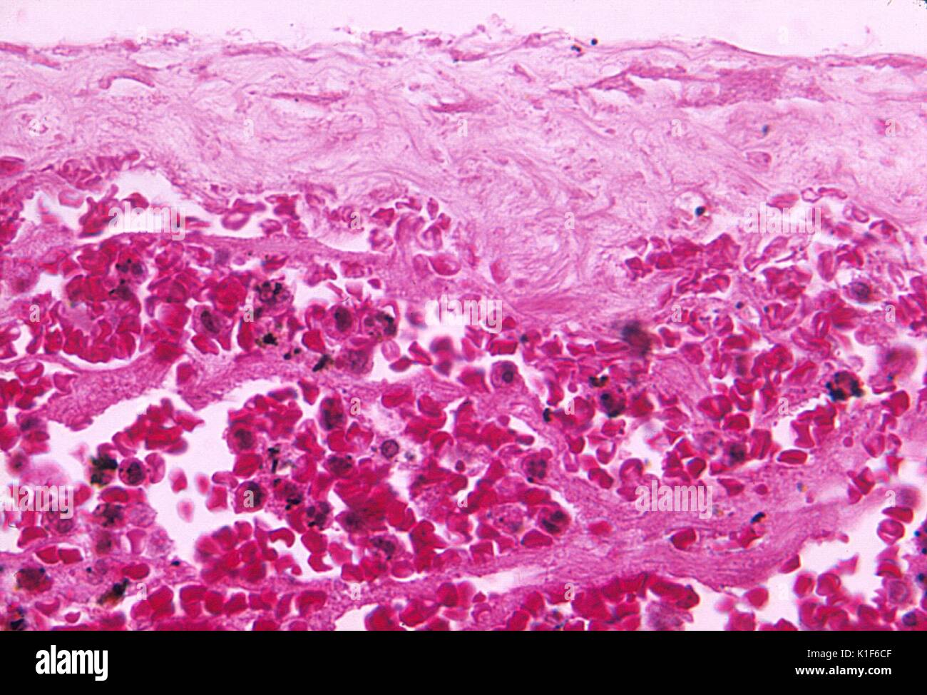 Photomicrographie de méninges hémorragie fatale due à la démonstration de charbon par inhalation, Mag. 500x. Image courtoisie CDC/Dr. LaForce, 1967. Banque D'Images