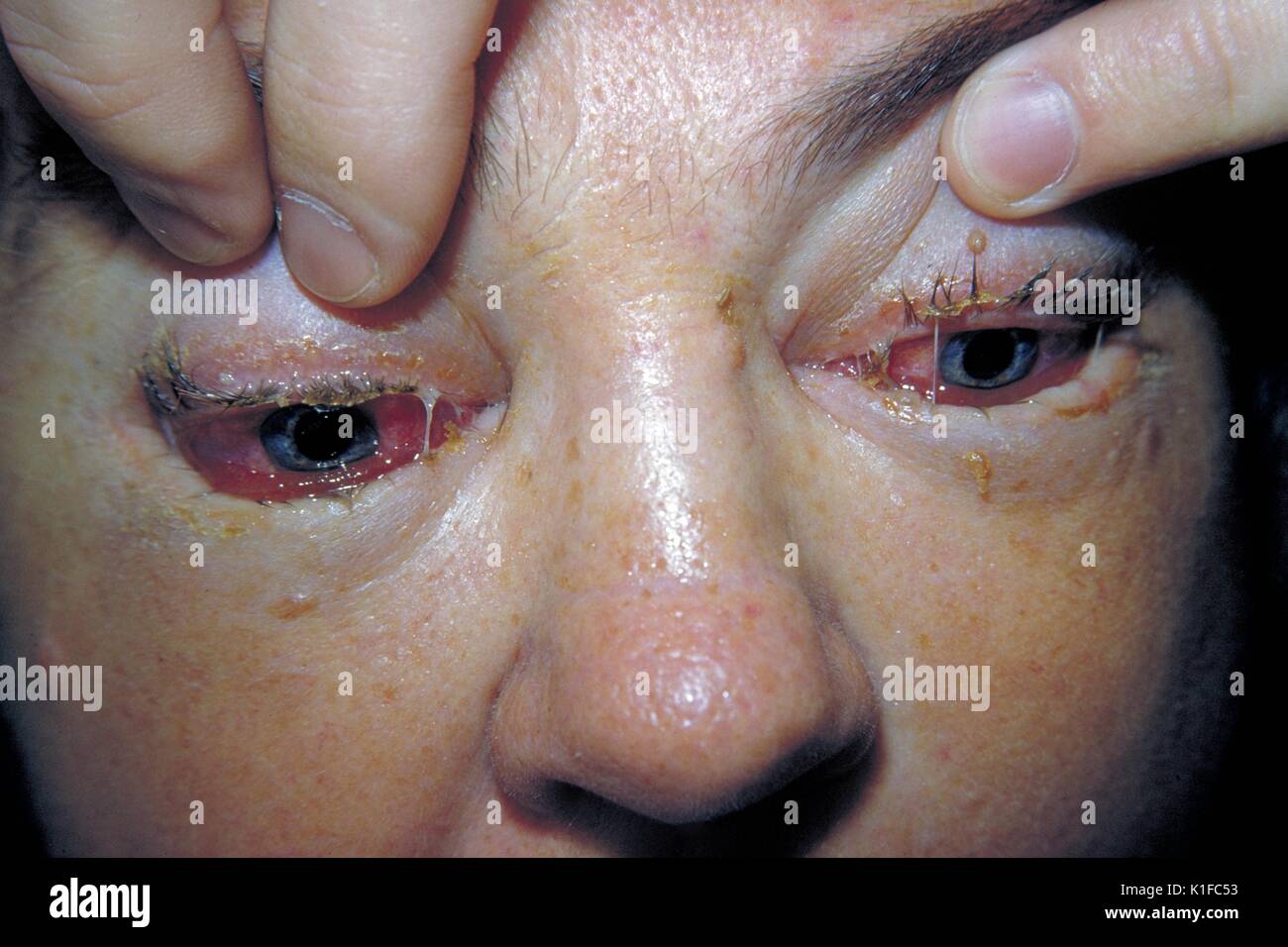 L'aspect clinique des yeux à la trichinose. A Patient œdème péri ...