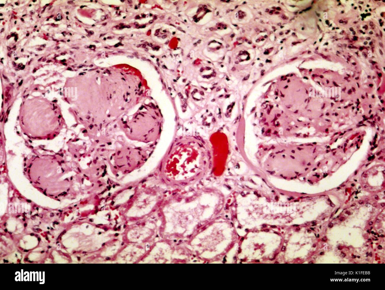 L'histopathologie de la glomérulosclérose nodulaire révélant des reins (syndrome de Kimmelstiel-Wilson), caractéristique du diabète. . Image courtoisie CDC/Dr. Edwin P. Ewing, Jr., 1974. Banque D'Images