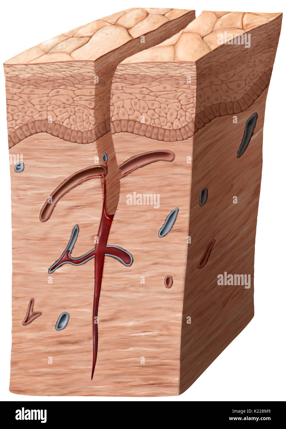 Lorsqu'une blessure atteint jusqu'au derme, les capillaires dans les éclater, causant une hémorragie. Un caillot sanguin se forme dans la partie inférieure de la plaie. Banque D'Images