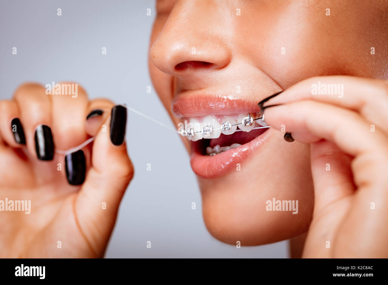 Close-up of a smiling girl face à bretelles soie dentaire les dents. Banque D'Images