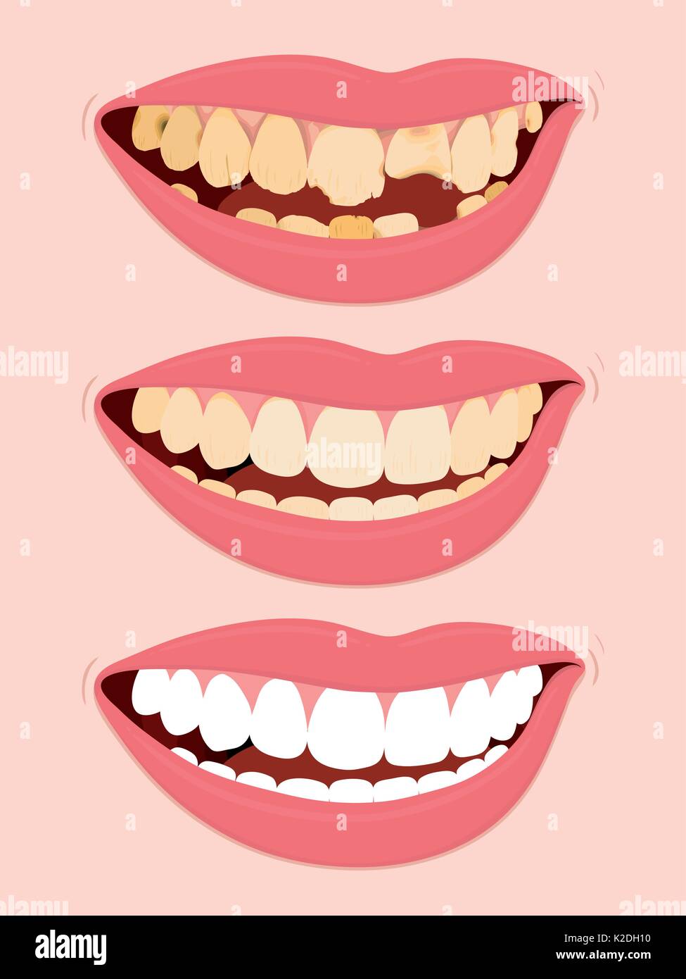 Étapes de la décomposition dentaire, illustration d'ouvrir la bouche féminine montrant trois étapes pour dents pourries Illustration de Vecteur
