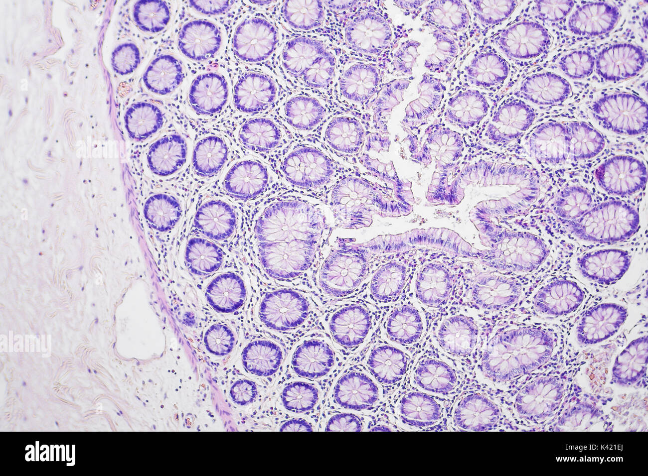 La photographie microscopique du cancer du côlon, grossissement x100 Banque D'Images