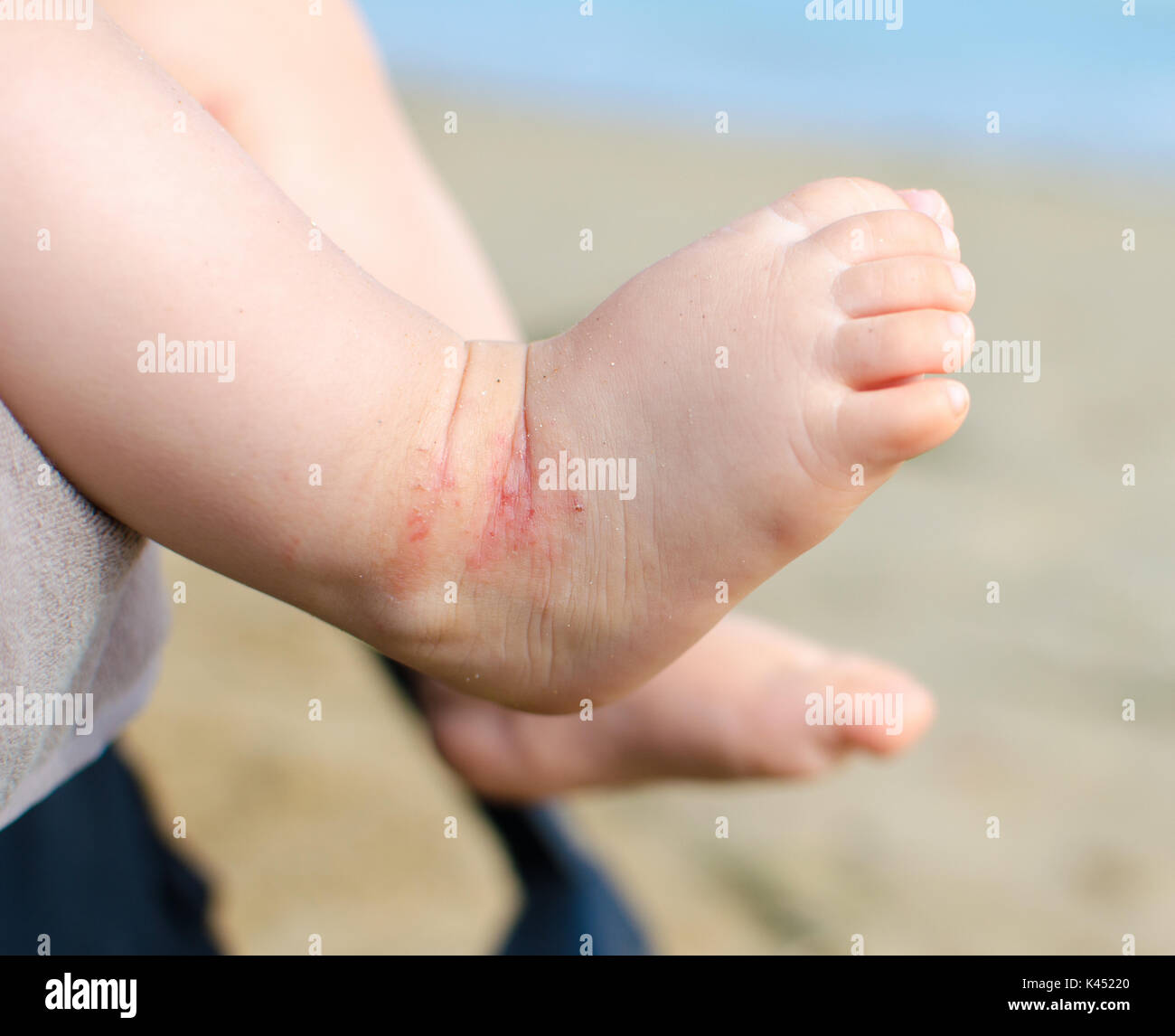 La dermatite atopique l'eczéma des pieds du nouveau-né Banque D'Images