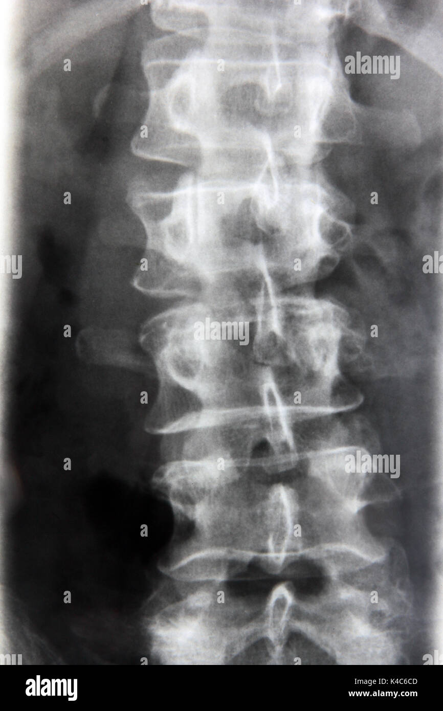 Human vertebras Banque de photographies et d’images à haute résolution — free download