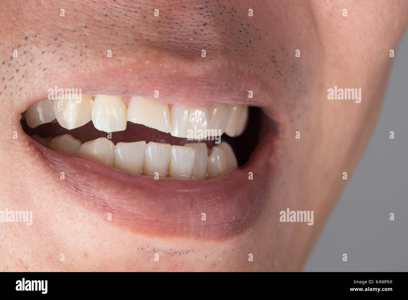 Les blessures ou la rupture des dents Dents en homme et traumatisme d'un nerf de la dent, les dents permanentes de blessés graves. Banque D'Images