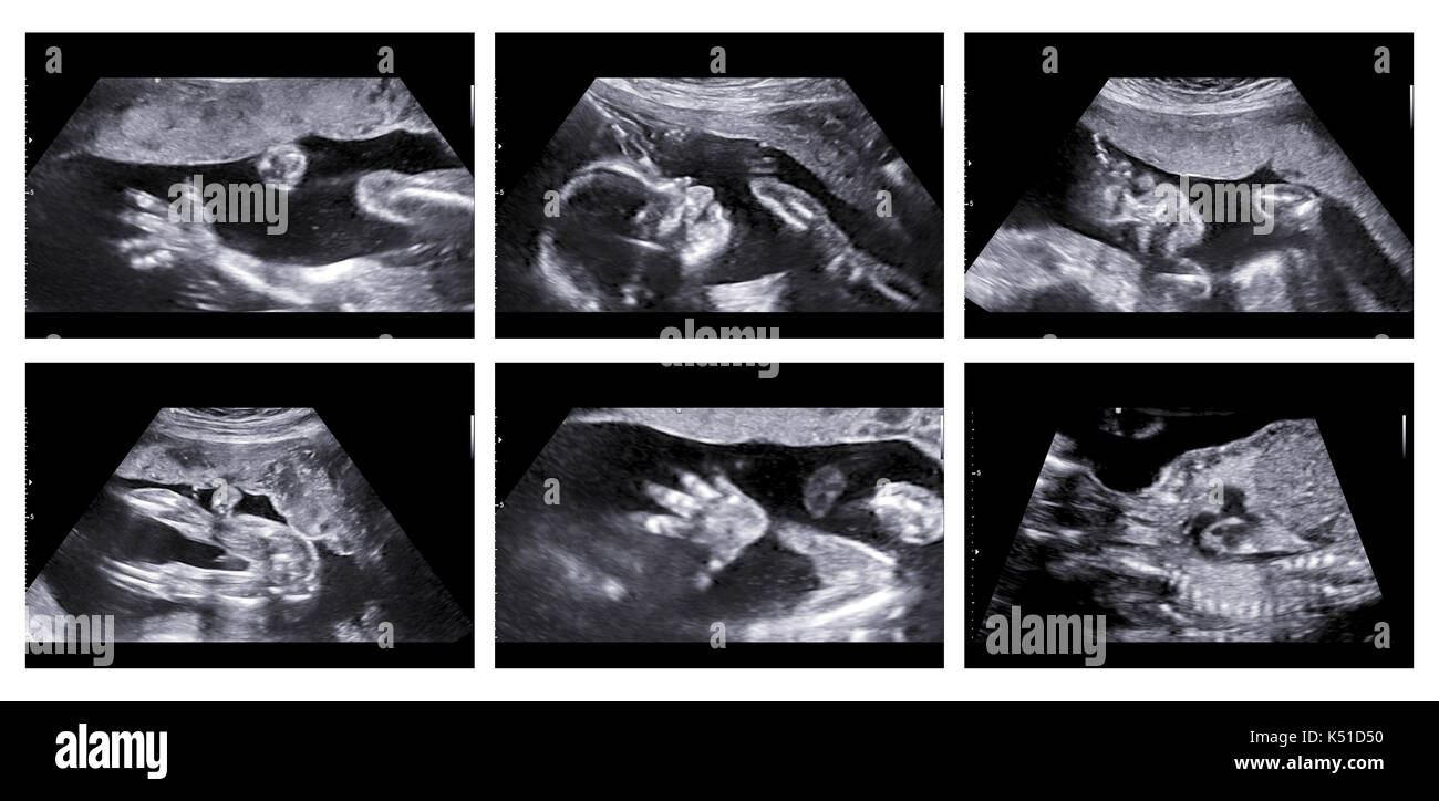 Collage d'images médicales de l'anomalie échographique acquisition sur un fœtus féminin 20 semaines de grossesse, montrant la main de l'enfant, tête, pieds, jambes, dos et Banque D'Images