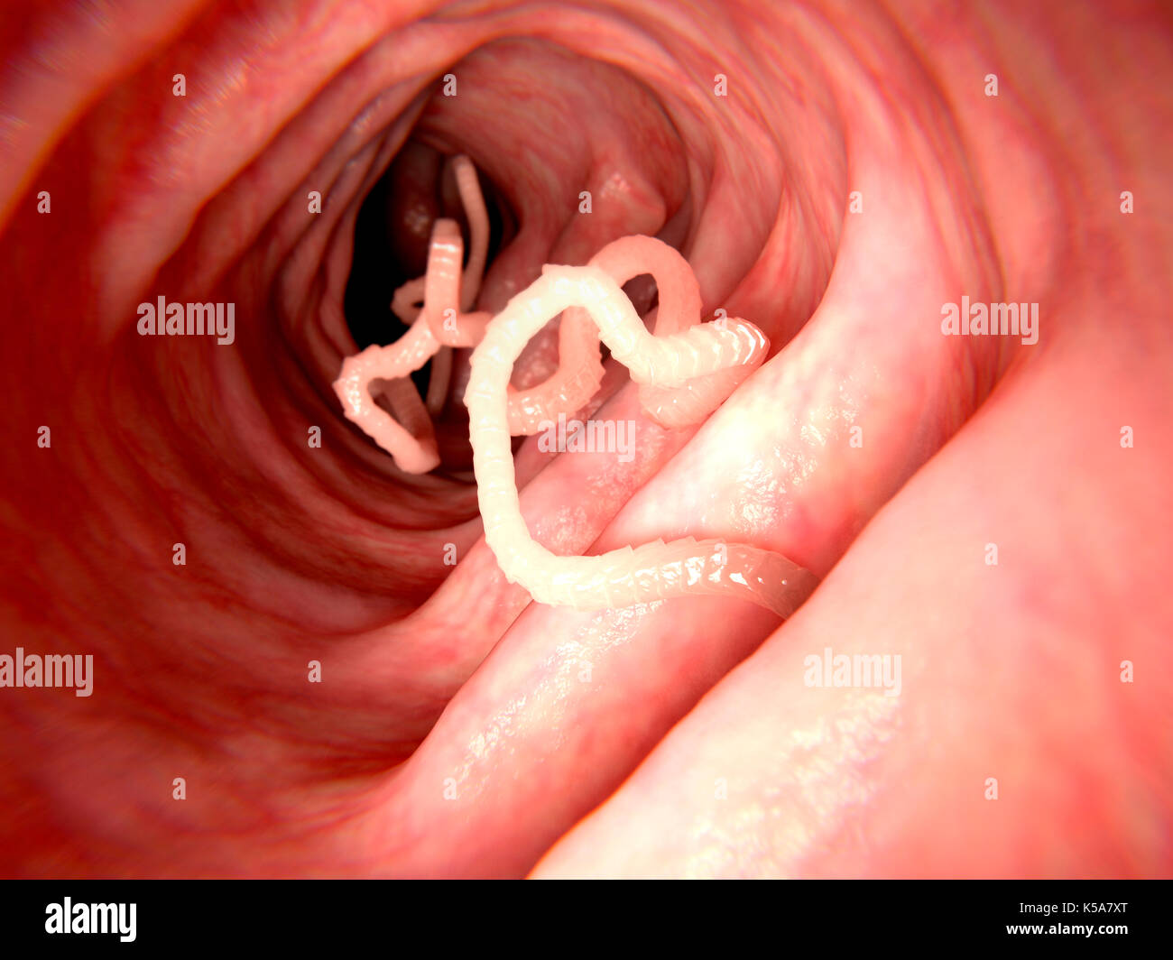 Illustration d'un ver solitaire dans un intestin humain. Les ténias (Taenia  sp.) sont des parasites qui vivent dans l'intestin humain. Ils ont  d'eux-mêmes à l'intérieur de l'intestin et d'absorber les nutriments dans