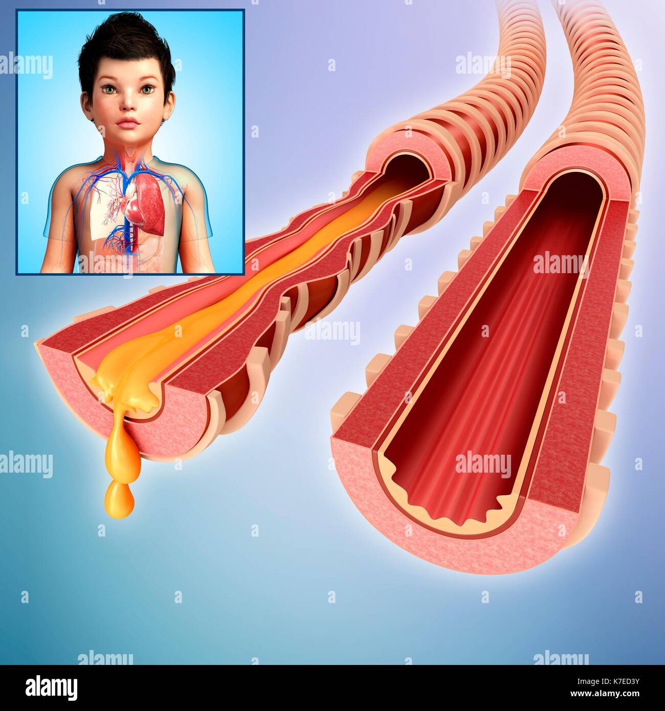 Illustration d'un enfant est infecté et bronches normales. Banque D'Images