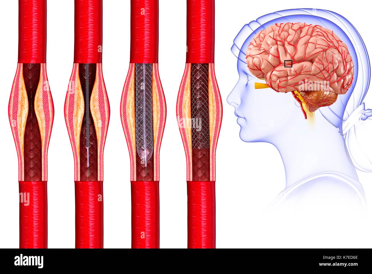 Illustration de l'angioplastie stent du cerveau pour traiter et prévenir un AVC. Banque D'Images