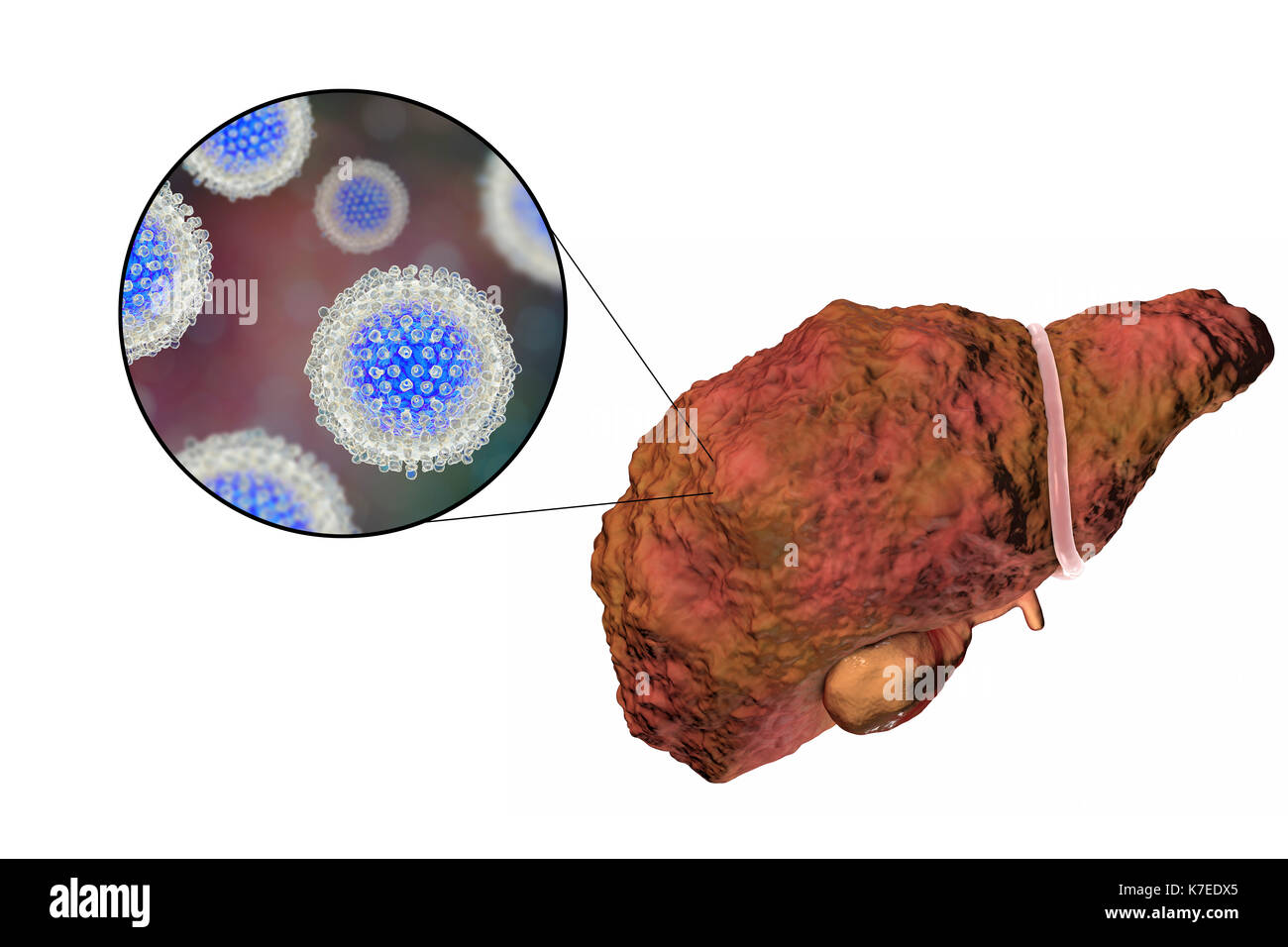 Illustration d'ordinateur d'un foie cirrhotique et un close-up de l'hépatite C les virus. L'hépatite C est une cause fréquente de l'hépatite chronique qui évolue vers la cirrhose du foie. Les virus causent la mort cellulaire (nécrose) dans les lobules hépatique, ce qui conduit à des cicatrices. Ceci provoque la surface du foie à apparaître de manière irrégulière et de bosses au lieu de l'habituelle bonne apparence saine. La maladie est irréversible et peut conduire à un cancer du foie. Banque D'Images