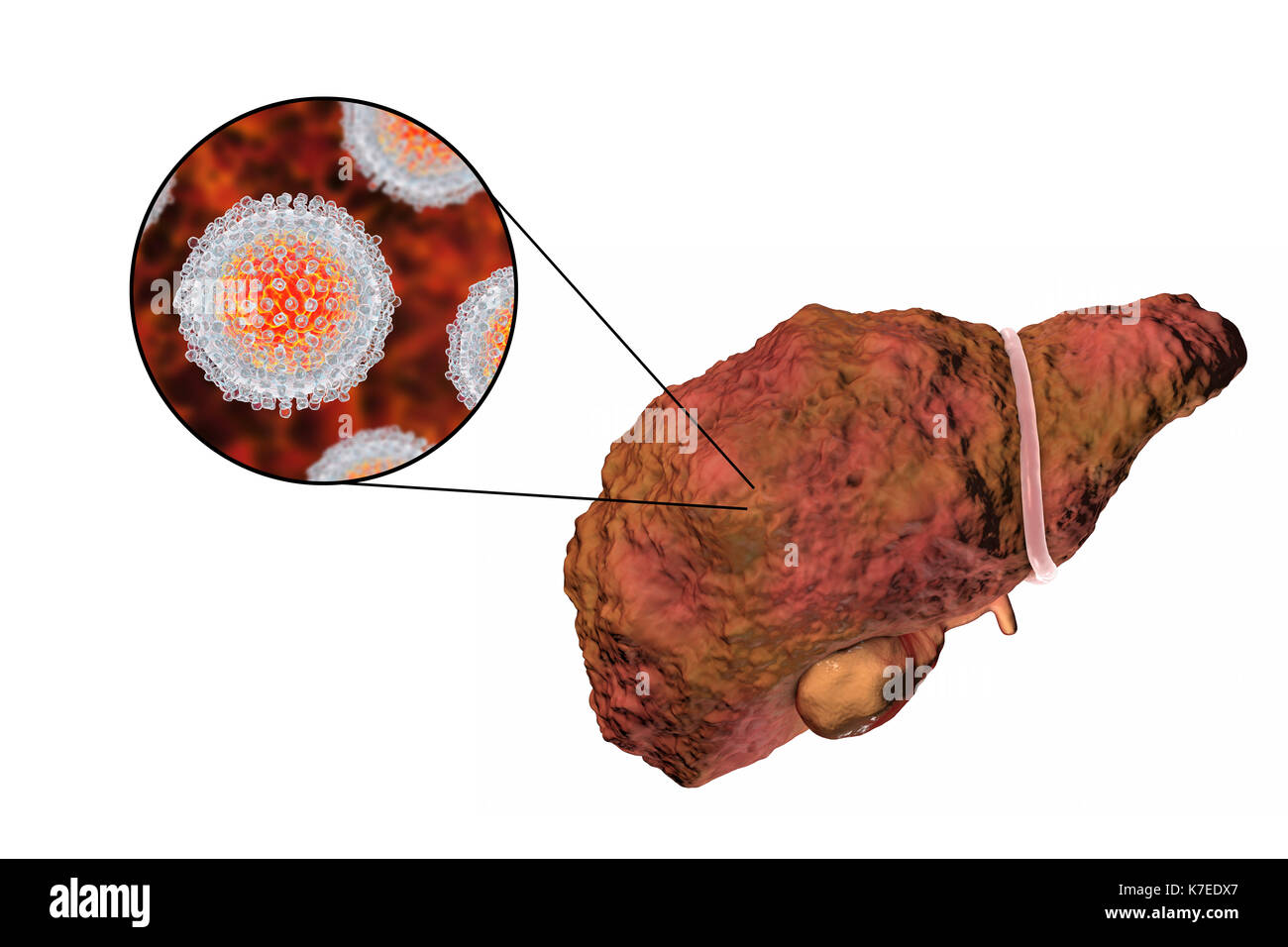 Illustration d'ordinateur d'un foie cirrhotique et un close-up de l'hépatite C les virus. L'hépatite C est une cause fréquente de l'hépatite chronique qui évolue vers la cirrhose du foie. Les virus causent la mort cellulaire (nécrose) dans les lobules hépatique, ce qui conduit à des cicatrices. Ceci provoque la surface du foie à apparaître de manière irrégulière et de bosses au lieu de l'habituelle bonne apparence saine. La maladie est irréversible et peut conduire à un cancer du foie. Banque D'Images