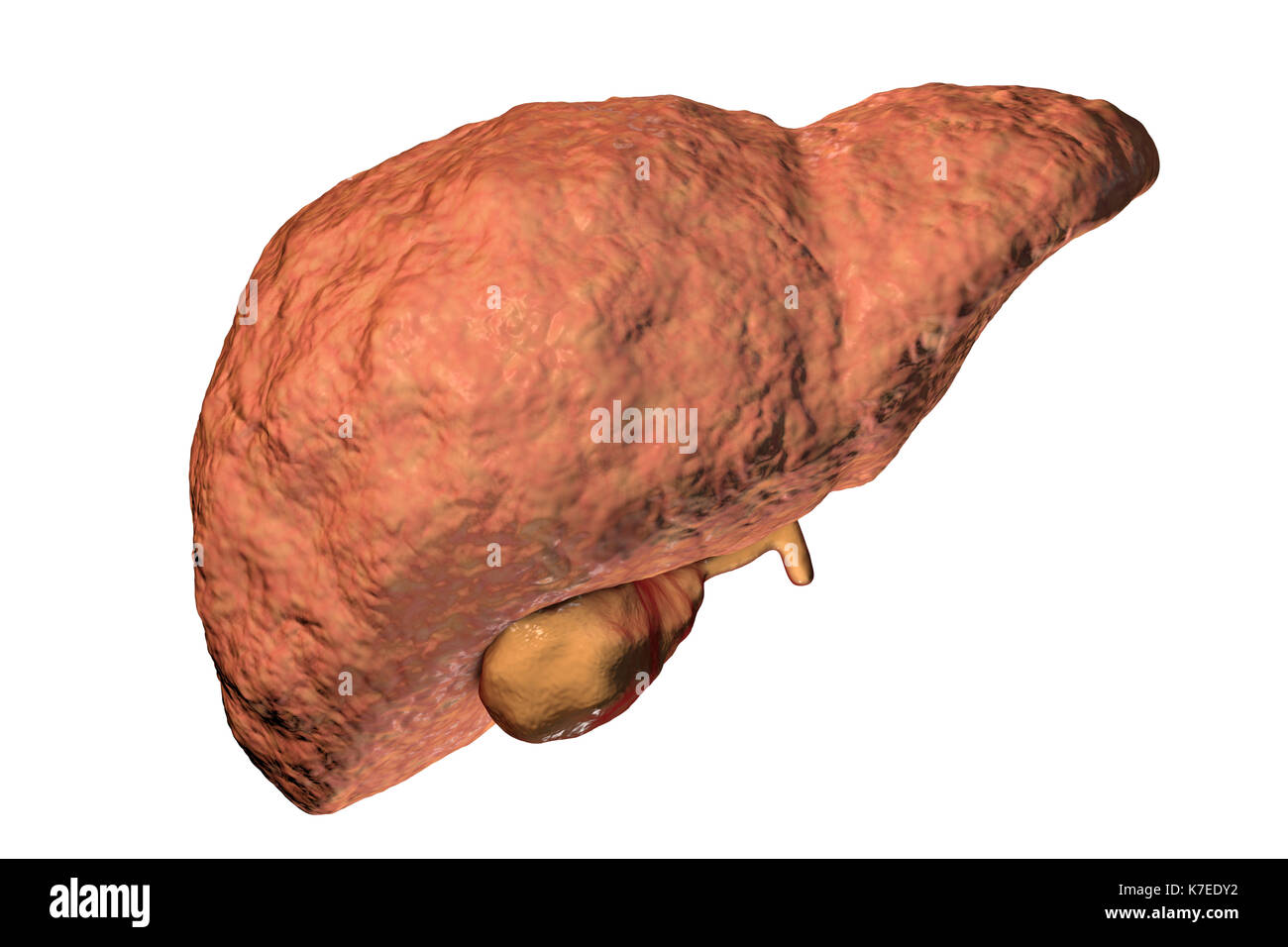 Les droits de la stéatose hépatique montrant des signes de fibrose, illustration de l'ordinateur. Banque D'Images