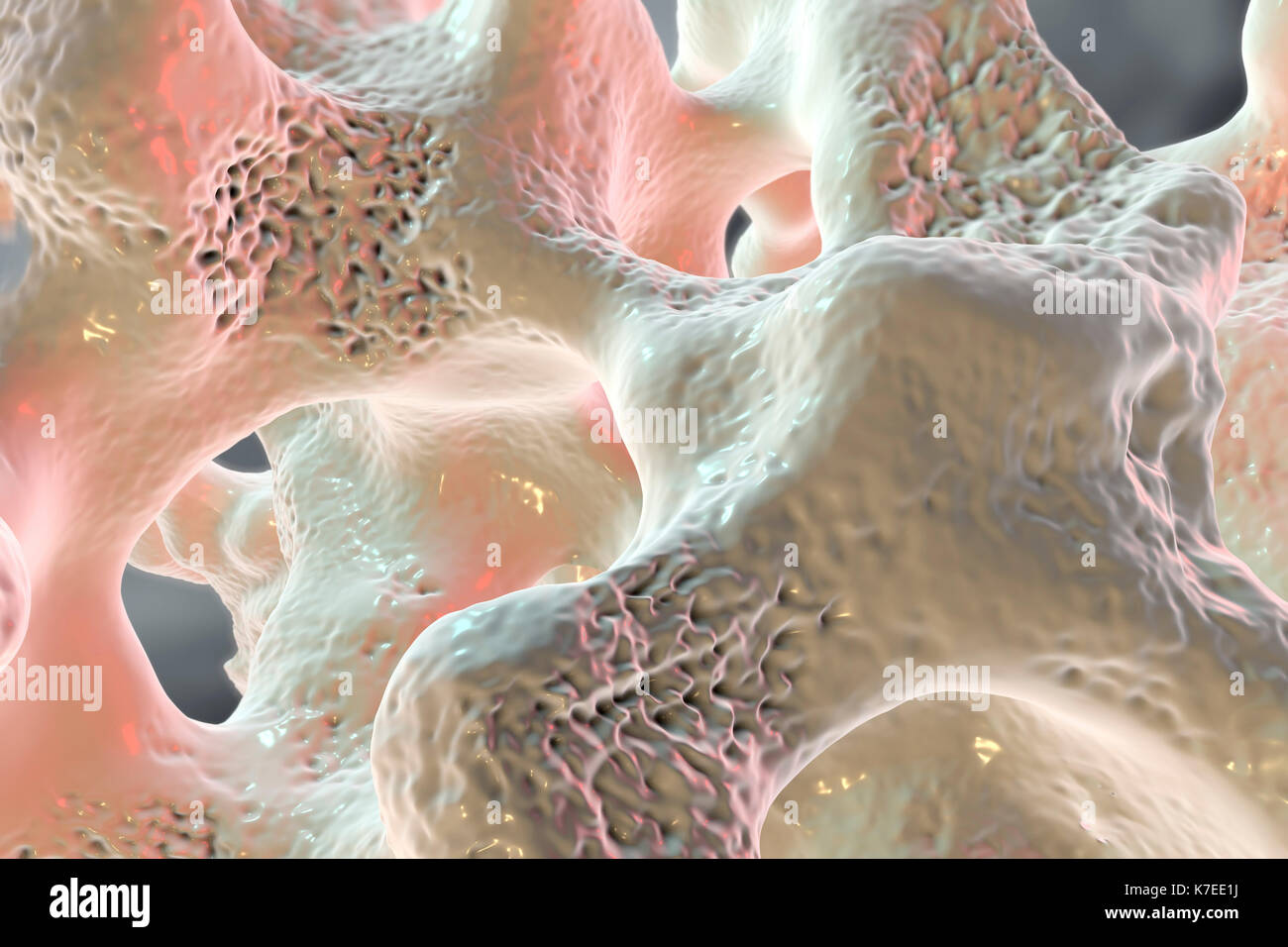 Illustration de la structure osseuse touchés par l'ostéoporose. Amincissement de la matrice osseuse est visible. Banque D'Images