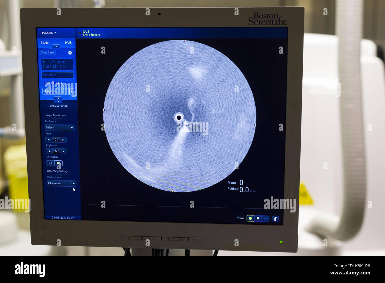 L'ablation par radiofréquence Banque D'Images
